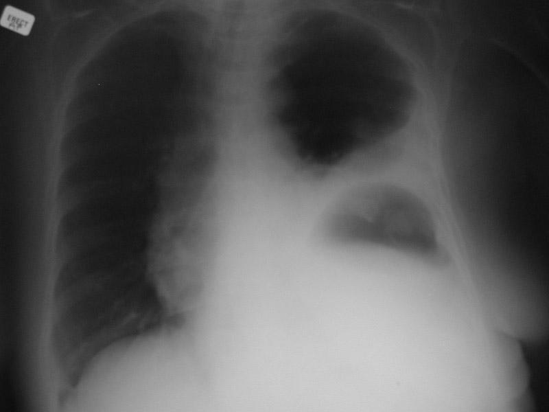 MEDIDAS AUXILIARES AVALIAÇÃO PRIMÁRIA Frequência respiratória e gasometria arterial Oximetria de pulso