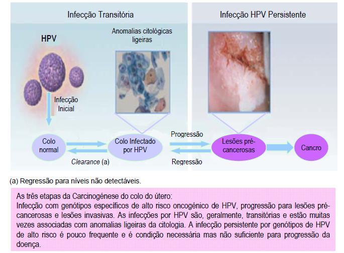 4 História natural da infecção por HPV Figura 8 Carcinogénese do CCU. (Fonte: Direcção-Geral da Saúde Comissão Técnica de Vacinação.
