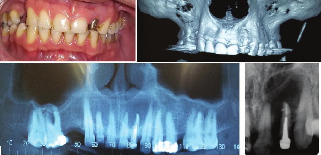 A B COMIM, Letícia et al. Figura 1 - A Aspecto clínico inicial. B Tomografia da maxila e região da lesão. C Vista frontal tomagráfica da lesão apical no 22. C D B D Radiografia periapical da lesão.