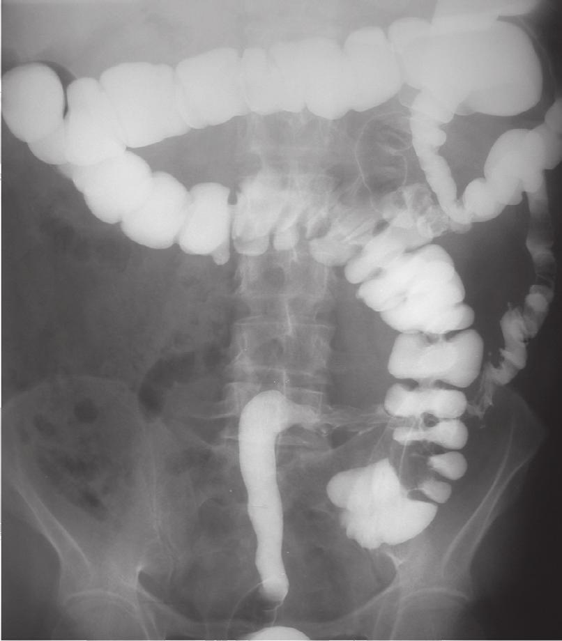 mografia computorizada torácica bronquiectasias cilíndricas dispersas nos lobos inferiores; ecocardiograma dilatação e hipertrofia do ventrículo esquerdo; clister opaco malrotação intestinal, o cego