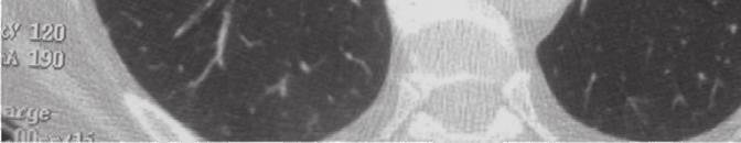 O teste da sacarina que avalia a clearance mucociliar; o doseamento do óxido nítrico expirado que estará diminuído; e a frequência do batimento ciliar observado em microscopia óptica em células da