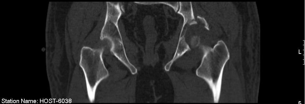 Imagem 10- Doente 4, fractura da parede posterior Imagem 11 e 12 - Doente 18, fractura luxação da anca Escolha da abordagem cirúrgica Em relação à