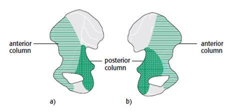 Revisão da Literatura O acetábulo ou cavidade cotiloideia é uma estrutura anatómica do osso ilíaco.