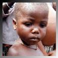 Kwashiorkor Hipoalbuminemia crônica versus