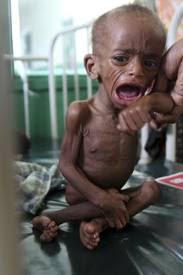 Subnutrição infantil intra hospitalar Subnutrição crônica Redução da massa