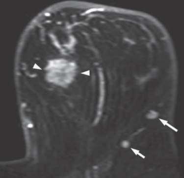 + Material e Métodos Achados na RM mamária Doença multicêntrica