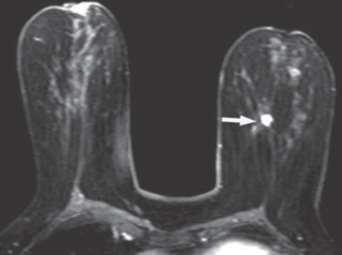 + Material e Métodos Achados na RM mamária