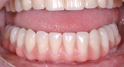 Randow K, Ericsson I, Nilner K, Petersson A, Glantz PO. Immediate functional loading of Brånemark dental implants. An 18-month clinical follow-up study. Clin. Oral Implants Res. 1999; 10: 8 15. 5.