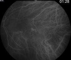 só evidencia sinais indirectos: adelgaçamento retiniano nas camadas externas da retina, com perda da densidade