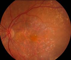 UTOFLUORESCÊNCI DMI atrófica Identificação das áreas de perda do EPR, quantificar as áreas de atrofia de uma forma mais precisa e monitorização e estimar a