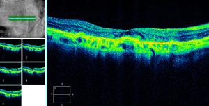 Os drusens podem observar-se como hipo, iso e hiperautofluorescentes. Os drusens cristalinos caracterizam-se por uma hipoautofluorescência.