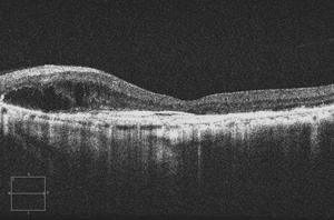 limites mal definidos, que eleva a retina em forma de gôndola.