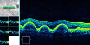 Espaço hiporeflectivo no seu interior. UTOFLUORESCÊNCI Descolamento drusenóide 1 B 1 Fig.