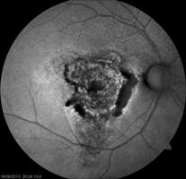 O padrão mais comum é uma hipoautofluorescência, resultado de uma perda total de células fotoreceptoras e EPR.