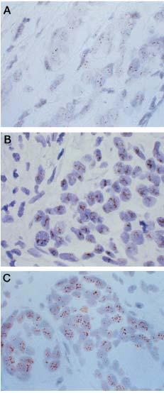 Figura 5. CISH (Hibridização in situ cromogênica) Esta figura mostra exemplos do método CISH para o oncogene Her-2 no CM.