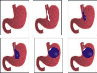 realizado por endoscopia para o implante de prótese de silicone, visando diminuir a capacidade gástrica e provocar saciedade.