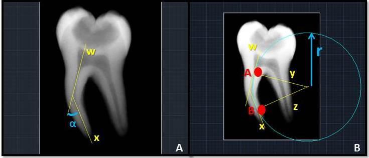 51 canal radicular.