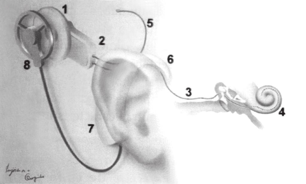 Figura 1: Implante coclear multicanal. Dispositivos internos e externos posicionados (Nucleus 24). 1. Antena interna colocada abaixo da pele 5. Eletrodo colocado abaixo do músculo 2.