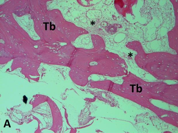 Em 4 das 5 amostras colhidas do osso formado a partir do substituto ósseo sintético Straumann Bone Ceramic, foram observadas trabéculas ósseas bem