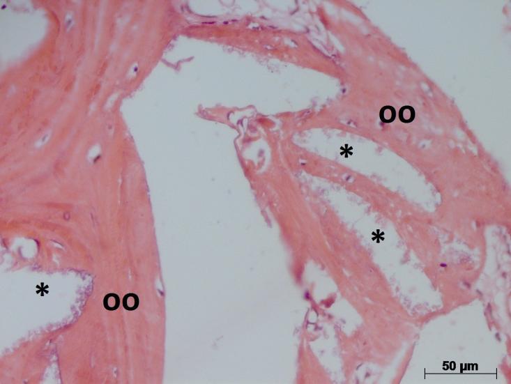 Figura 2: A - Fotomicroscopia ilustrando a presença de trabéculas ósseas viáveis (Tb), com espaços medulares preenchidos por tecido conjuntivo denso (asterisco).