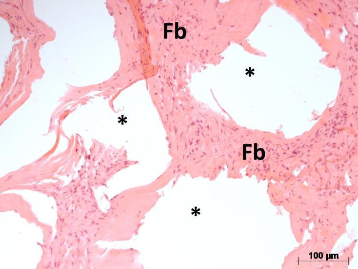 Hematoxilina Eosina, aumento original de 400x. Em 4 das 5 amostras observou-se um íntimo contato do tecido ósseo mineralizado recém formado, com as partículas do Straumann BoneCeramic (Figura 3).