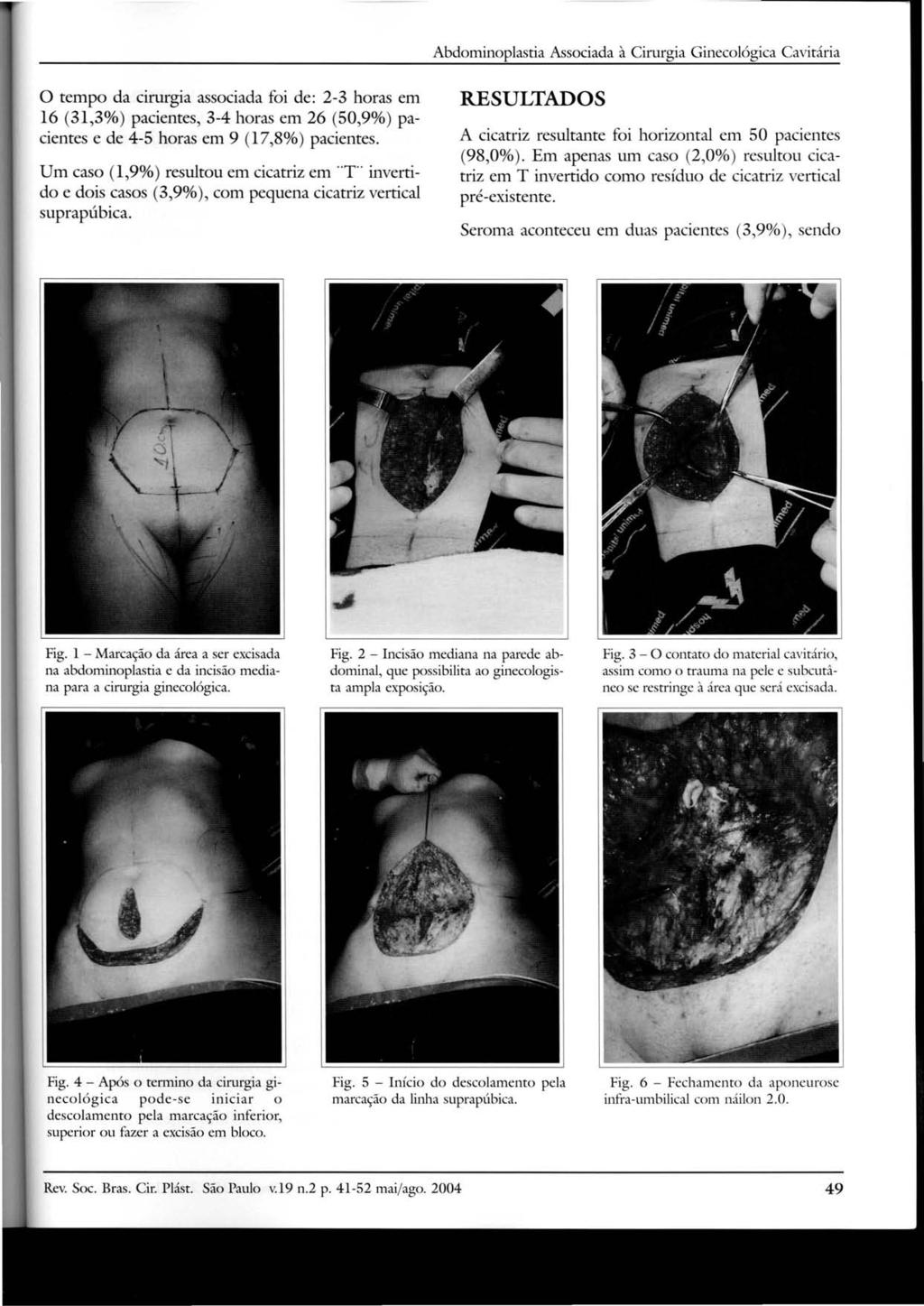 Abdominoplastia Associada à Cirurgia Ginecológica Cavitária o tempo da cirurgia associada foi de: 2-3 horas em 16 (31,3%) pacientes, 3-4 horas em 26 (50,9%) pacientes e de 4-5 horas em 9 (17,8%)