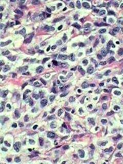 Medula óssea Mielóide Stem cell Sangue periférico Monócito Tecido Sarcoma histiocítico Macrófago Após a migração e maturação nos tecidos participa