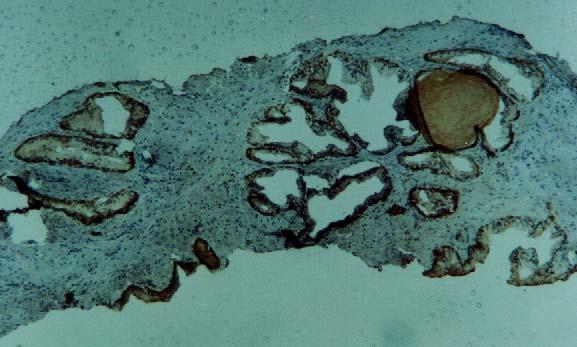 FIGURA 2: Exame imunohistoquímico com marcador de citoqueratina de alto peso molecular (34βE12), com aumento de 100X: