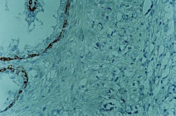 FIGURA 4: Exame imunohistoquímico com marcador de citoqueratina de alto peso molecular (34βE12), com aumento de 100X: Adenocarcinoma da próstata.