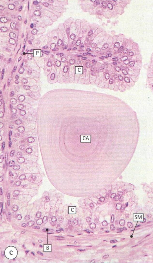 corpora amylacea: glicoproteína calcificada,