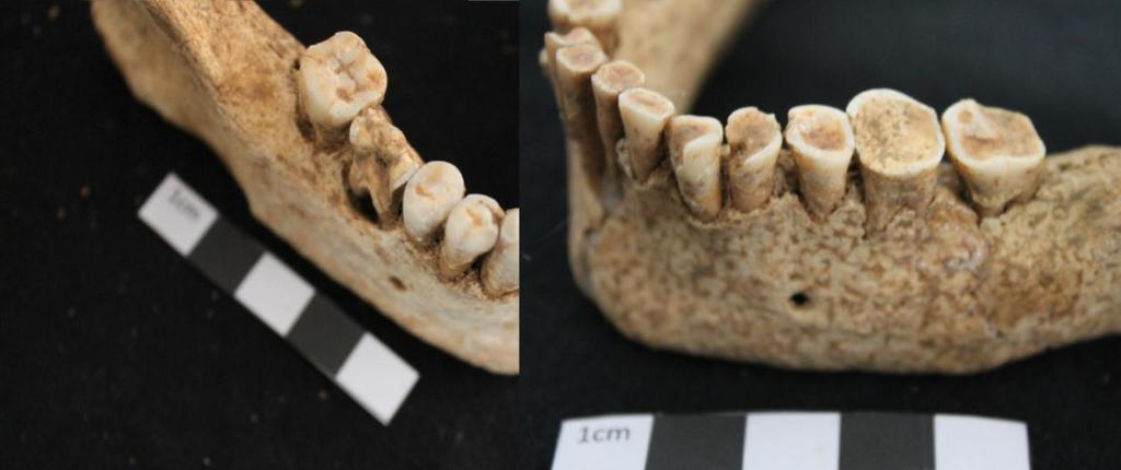 A B Figura 36 Fotografia relativa a indícios de uso da boca com fins extra-mastigatórios: A) lado direito da mandíbula de um indivíduo do sexo masculino (enterramento 75); B) lado