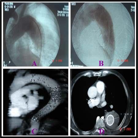 17 Figura 9 Exames de imagem do paciente número 2. (A) Aortografia pré-operatória; (B) Aortografia de controle pós-implante, com presença de vazamento tipo I.