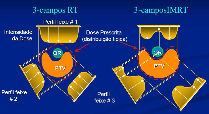 a serem feitos também aumenta proporcionalmente. Os resultados clínicos dão suporte ao uso da IMRT para vários tipos de câncer.