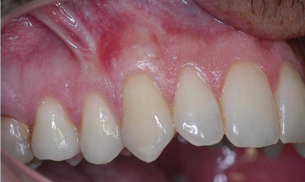 periodontal e o dente 23 onde não foi empregada