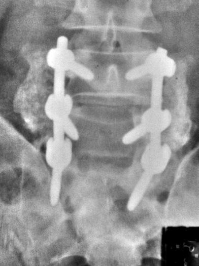 Análise da confiabilidade de métodos radiográficos para avaliação da artrodese posterolateral lombossacra 199 robservacional (4) e à moderada acurácia (60 e 70%) na determinação da fusão