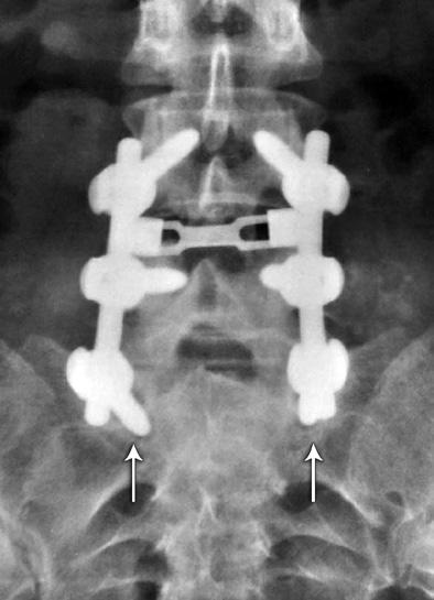 , (6) que consistem na mensuração de ângulo de Cobb entre as vértebras terminais da fusão. Os ângulos foram traçados em radiografias dinâmicas, em flexão e extensão máximas do tronco.