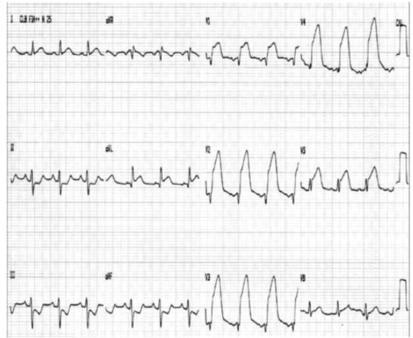 b) Insuficiência cardíaca aguda nova (perfil C). c) Insuficiência cardíaca crônica agudizada (perfil B). d) Insuficiência cardíaca crônica agudizada (perfil C).