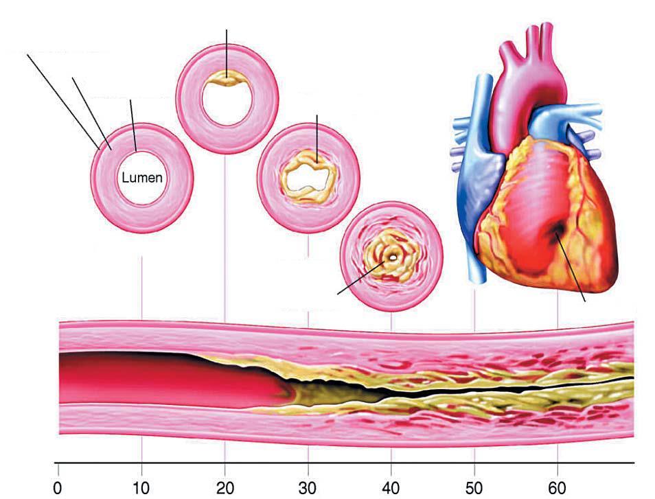 Progressão Natural da Placa Aterosclerótica Estria Gordurosa Túnica Adventícia Túnica Média Túnica Íntima Placa