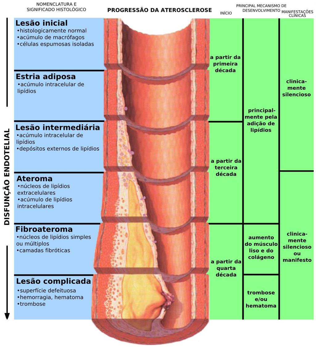 Lesão inicial acúmulo de lipoproteínas na íntima; lipídeos em macrófagos; Estria adiposa - acúmulo de lipoproteínas na íntima; lipídeos em macrófagos e em células musculares; Lesão intermediária dano