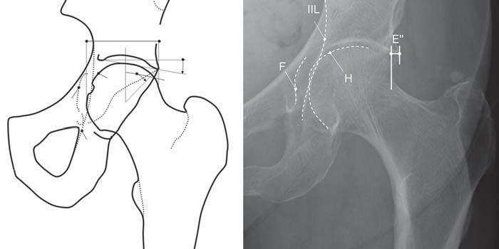 ; 2006) As incidências laterais são necessárias para visualizar a anatomia da junção anterior da cabeça-colo femoral, a qual não é visível na radiografia pélvica ântero-posterior.