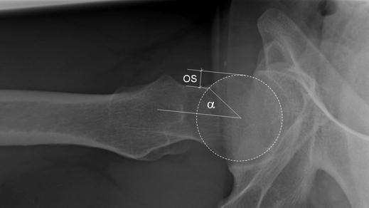 femoral (OS) com consecutivo aumento do ângulo alpha (α) Fonte: (TANNAST et al.