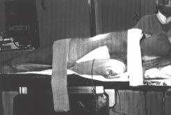 D.G. NASCIMENTO, L.C.S. MAIA, P.R. BRUM & F. CAVALLARI Fig. 1 Posicionamento do paciente após a abordagem posterior Fig. 2 Foto demonstrando divulsão do oblíquo externo Fig.