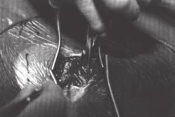 1a Foto demonstrando a inclinação lateral do paciente na mesa cirúrgica qual o grau de morbidade e complicações foi sensivelmente reduzido, proporcionando, dessa forma, maior aceitação da abordagem
