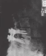 COMUNICAÇÃO PRELIMINAR DA TÉCNICA MINIALIF PARA ARTRODESE CIRCUNFERENCIAL DE ESPONDILOLISTESE DEGENERATIVA Fig. 10 Radiografia em perfil evidencia bom posicionamento do enxerto ósseo Fig.