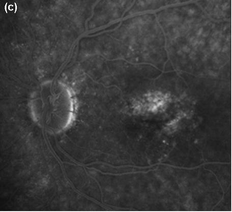 imagens centrados na mácula está recomendada para possibilitar a avaliação estereoscópica do fundo ocular (Royal College of Ophthalmologists, 2009).