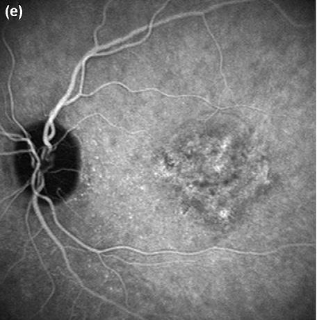 a a c: Sequência desde tempos iniciais a tardios, com aparição de uma placa de hiperfluorescência macular, correspondente a membrana neovascular oculta.