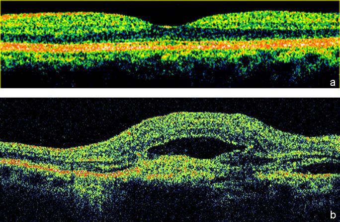 Introdução são capazes de capturar cerca de 400 scans A por minuto, com uma resolução entre 10 e 15 μm, permitindo a visualização das diferentes estruturas da retina e delineando parcialmente a