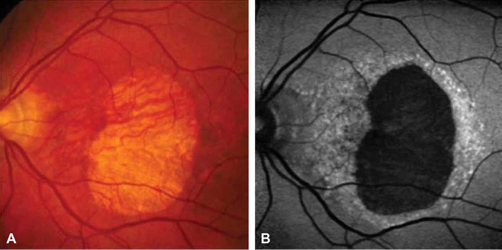 Introdução (5) Autofluorescência do fundo ocular, é um método não invasivo que proporciona informação adicional às técnicas de imagem convencionais, permitindo obter um mapa topográfico da