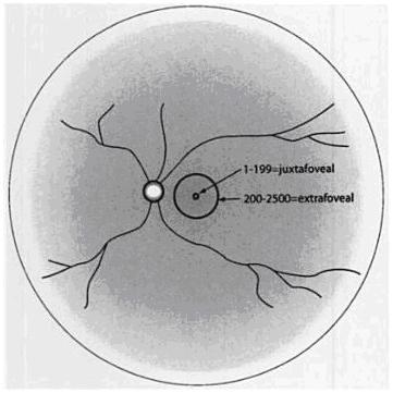 Introdução A classificação para a neovascularização coróideia actualmente em utilização foi desenvolvida pelo Macular Photocoagulation Study Group (cit.