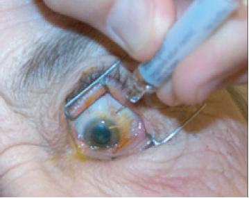 b: É aplicada esterelização da superfície ocular, com povidona-ioda.
